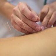 Acupuncture Horley