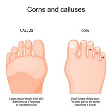 corn and calluses
